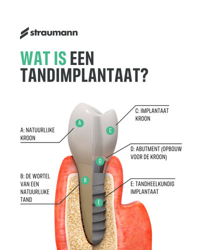 straumann implantaat uitleg
